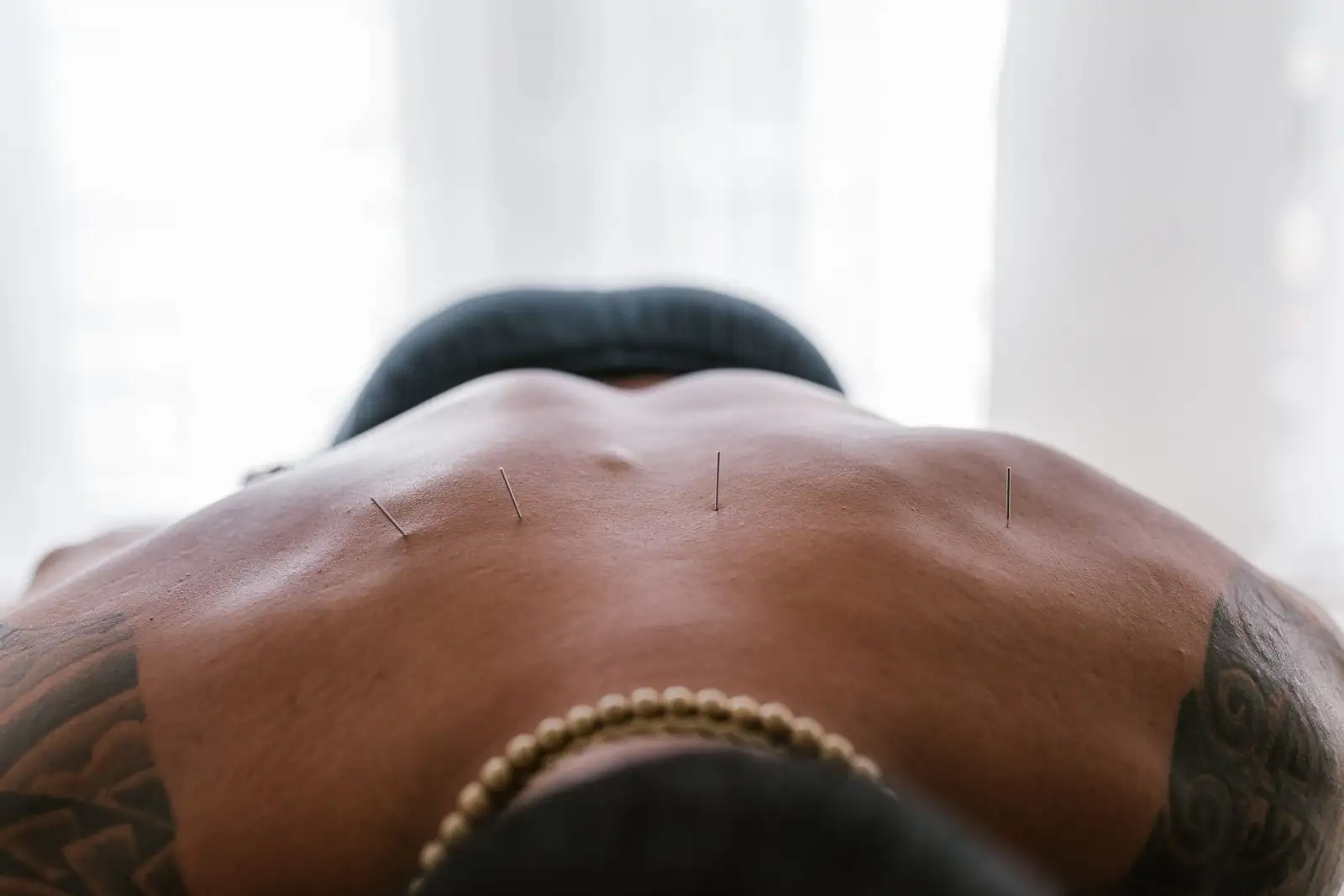 Acupuncture : à quoi ça sert et comment se déroule la séance
