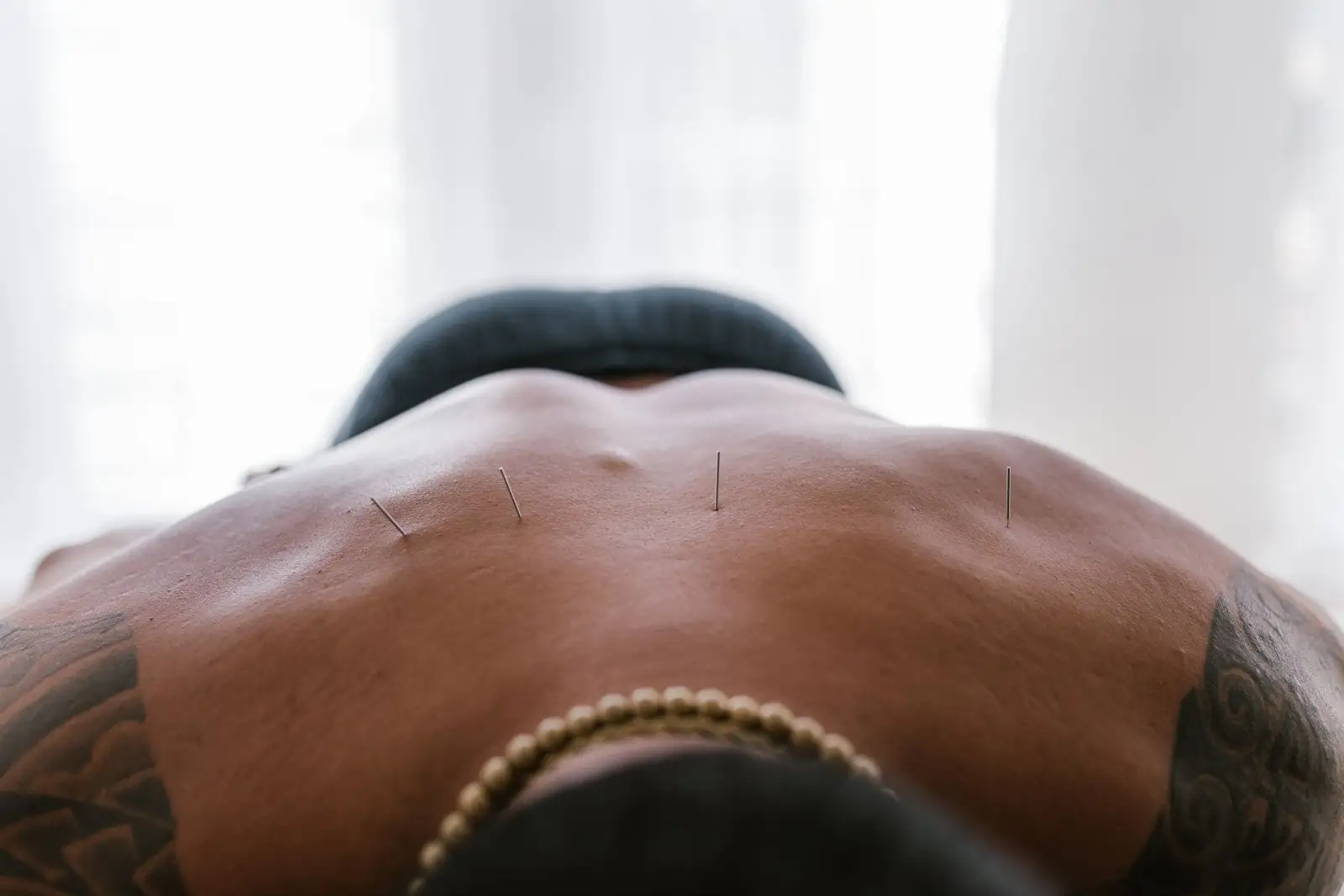 Acupuncture : à quoi ça sert et comment se déroule la séance